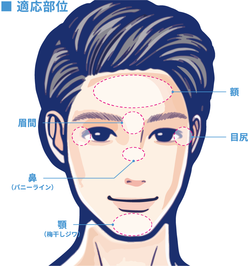 適応部位 額・眉間・目尻・鼻・顎