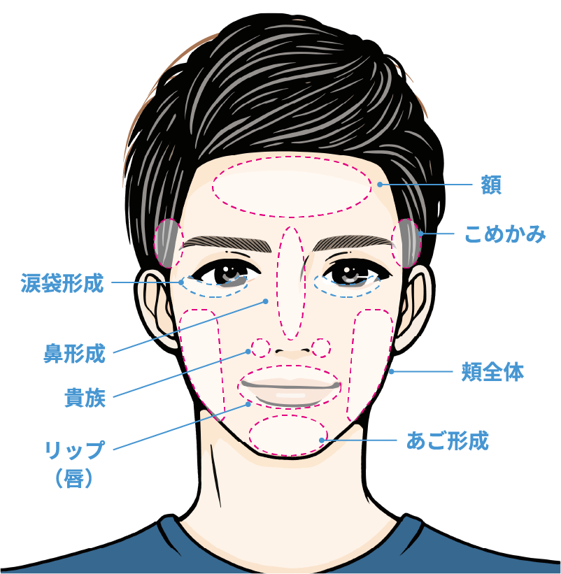 適応部位 広頚筋上部