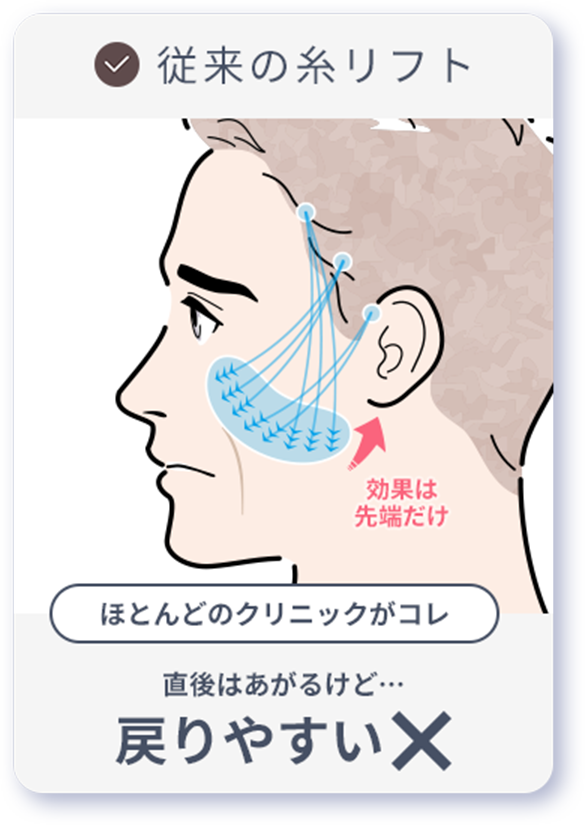 従来の糸リフト 直後は上がるけど戻りやすい