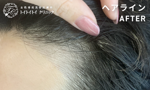 ヘアライン 5