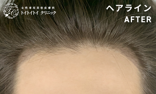 ヘアライン 10